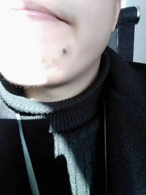 下巴痣下面起了个大包,摸起来微疼,不摸没事