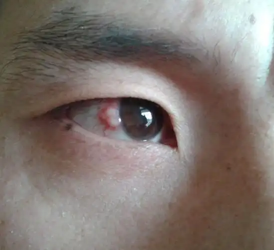 这是什么病眼睛长泡