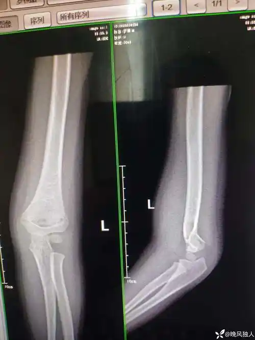 四岁的肱骨髁上骨折懂得人不懂的人都沉默了