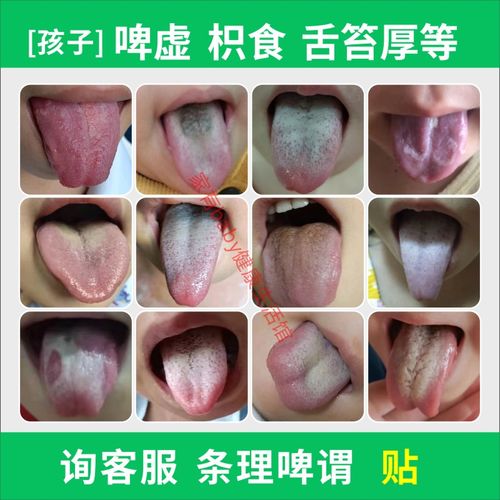 宝宝调理脾胃中药保健贴儿童舌苔厚地图舌口臭胀气小儿健脾消积食