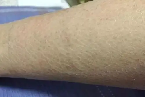 鱼鳞病是一种遗传性的角化障碍性皮肤病,主要是皮肤干燥伴有片状鱼