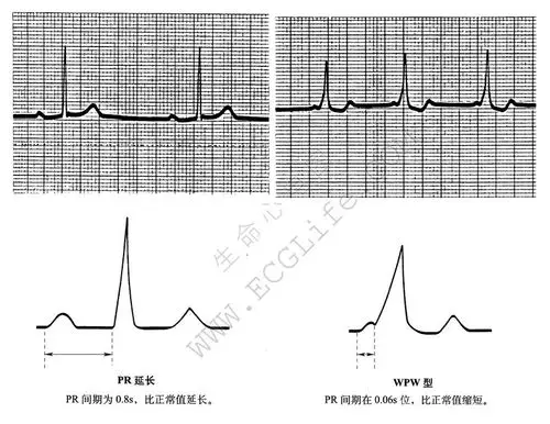 时间因素——间期的表现 - 心电图学 - 天山医学院