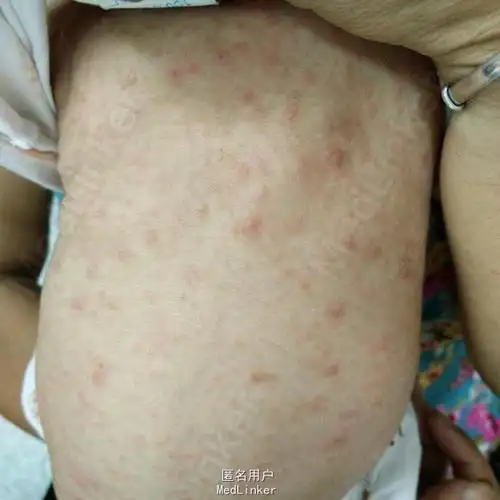病毒疹?警惕先天性梅毒!