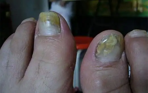 灰指甲的早期症状表现
