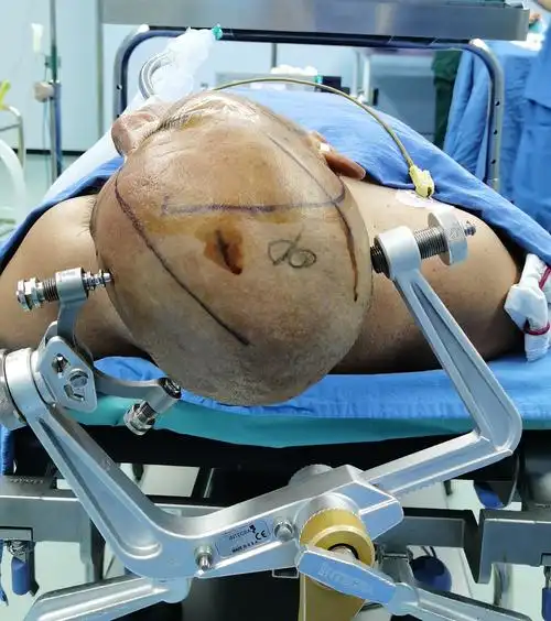 动脉黏连紧密的前床突脑膜瘤切除