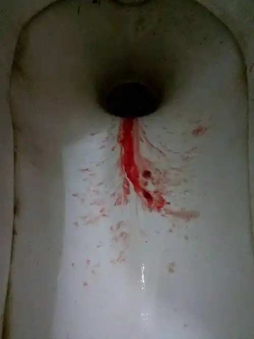 大号出血怎么回事?