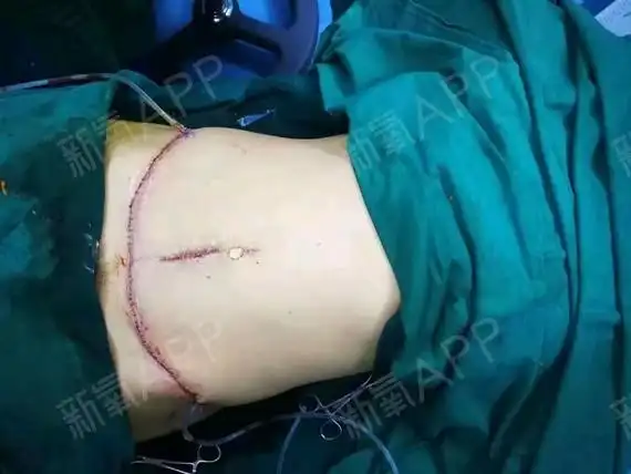 素鸢半暖画凉筝腹壁成形术第1天美丽日记-新氧美容整形