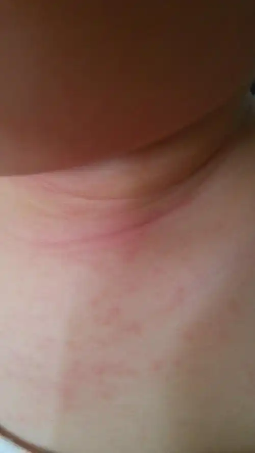 1岁宝宝痱子湿疹还是皮疹还是什么别的?麻烦帮忙看一看