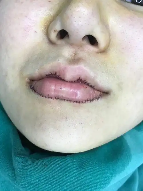 唇综合术后第一天,美唇的改变