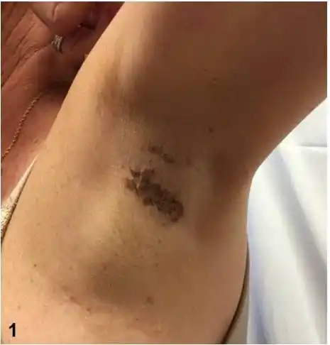 病例挑战:腋窝非对称性褐色丘疹和斑块