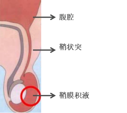 正常男宝宝在胎儿期阴囊与腹腔是相连通的,就像存在一条秘密的"隧道"