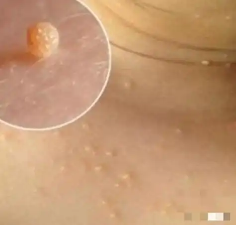 可能是丝状疣:腋下的小颗粒也有可能是丝状疣,一般身材肥胖或抵抗力