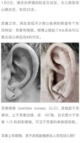 "耳朵褶皱"是冠心病迹象?符合这5点的人心脏更危险_管理