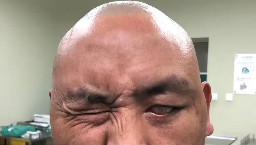 在手术治疗面瘫的路上越走越远