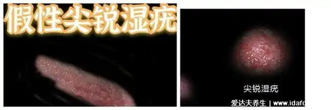 一,尖锐湿疣1,发病症状可以出现菜花状疣体的,而且不止是菜花状疣体