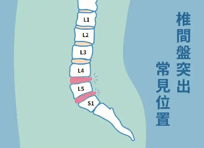 我们人体有5个腰椎,椎体与椎体之间有一个柔软而富有弹性的组织,就是