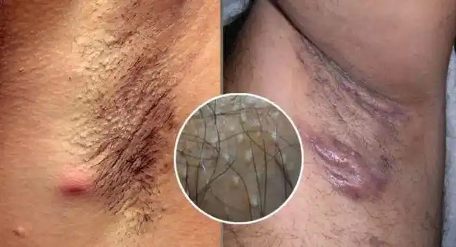 通过抑制细菌生长 直接作用于大汗腺,双管齐下去除异味.