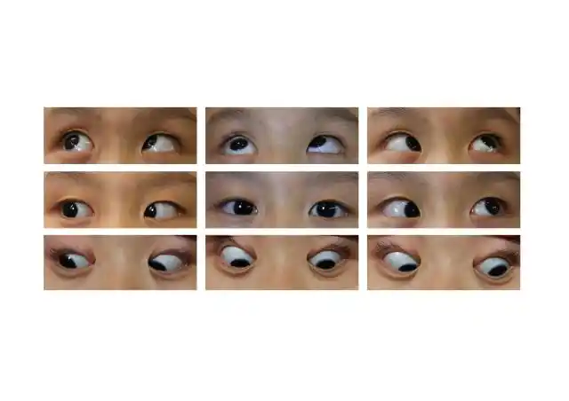 斜视是指两眼不能同时注视目标,属眼外肌疾病,可分为共同性斜视和麻痹