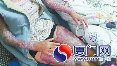 被烧伤后惨不忍睹.