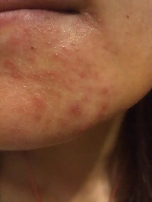 ">皮肤过敏 /a> a href="#" data-lemmaid="1507127">症状 /a>是发痒