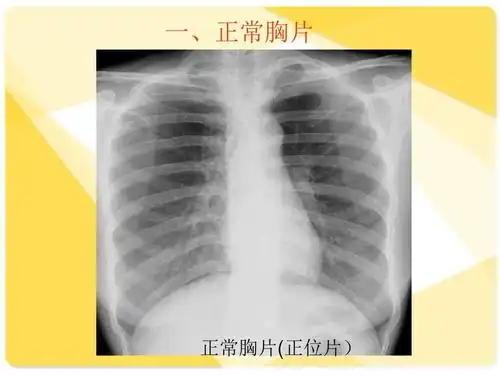 肺部疾病影像学阅片ppt