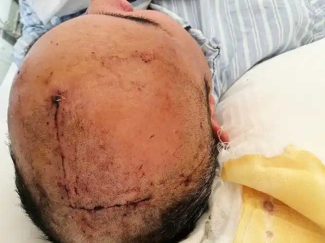 病人感叹说还是中国手术技术好,还是冬雷团队好!