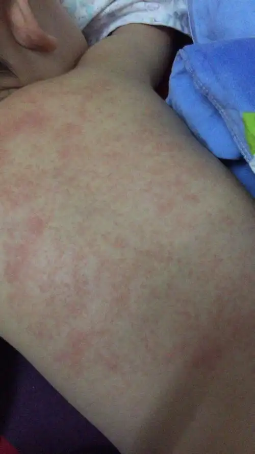 就背上有的,都几次了,好像都是发烧生病时有的,宝宝很痒,急急急急?