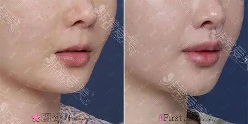 初见整形外科人中缩短术对比图