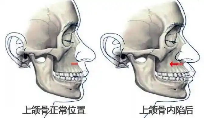 随着年龄增长,面部中间的上颌骨会开始内陷,使鼻唇沟越来越深