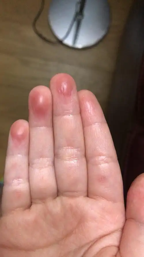 小孩子手指头红肿