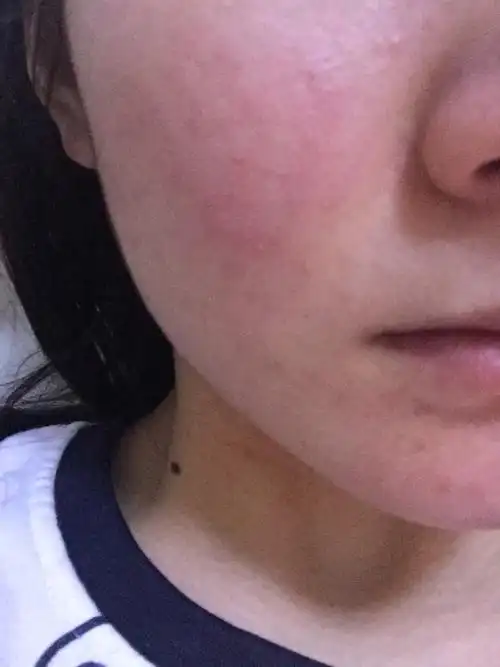 有没有宝妈怀孕脸上总是过敏的