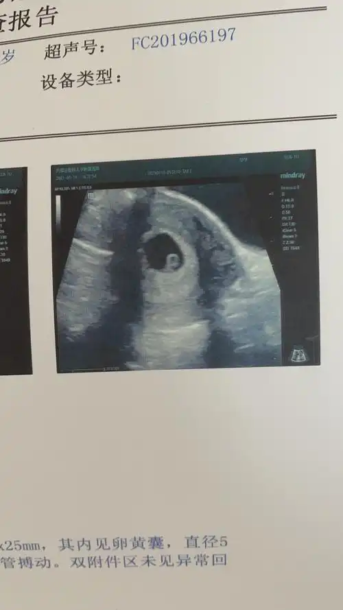 6周,这是小人形还是孕囊