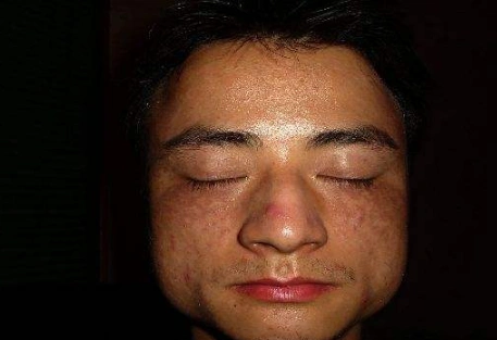 脸上肝斑图片57