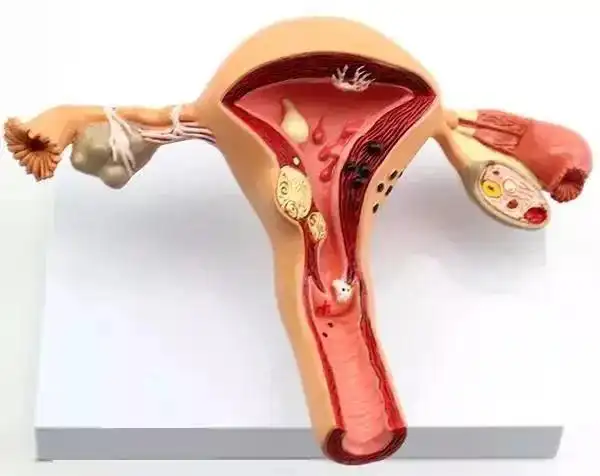 子宫内膜息肉是什么?