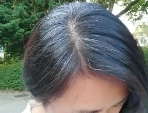 女性白发日渐增多不要以为是自己老了可能是缺乏3种营养