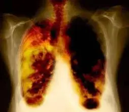 肺癌晚期死前症状图片