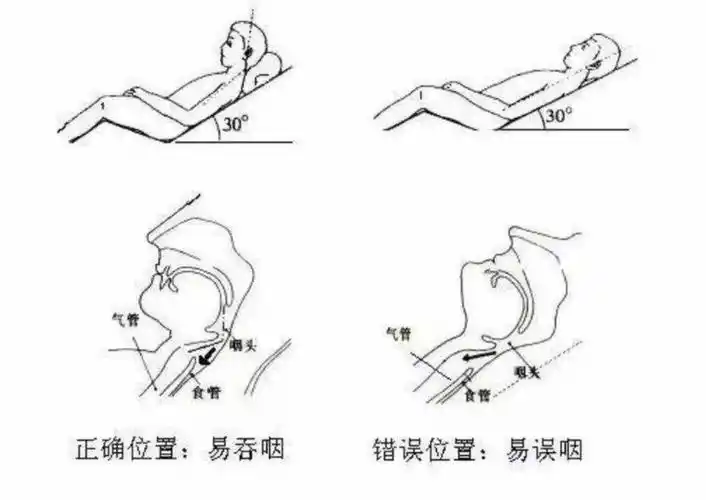 【讲堂】康复小讲堂之:吞咽患者的康复训练指导