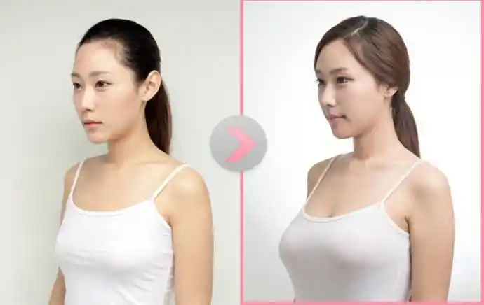 芜湖伊莱美隆胸手术大概需要多少钱