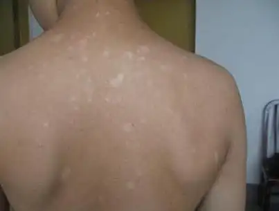 白癜风最开始的形状