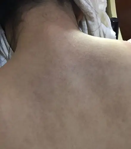 想问下好几年了 很像色斑一块块的是不是什么皮肤病不痒没感觉