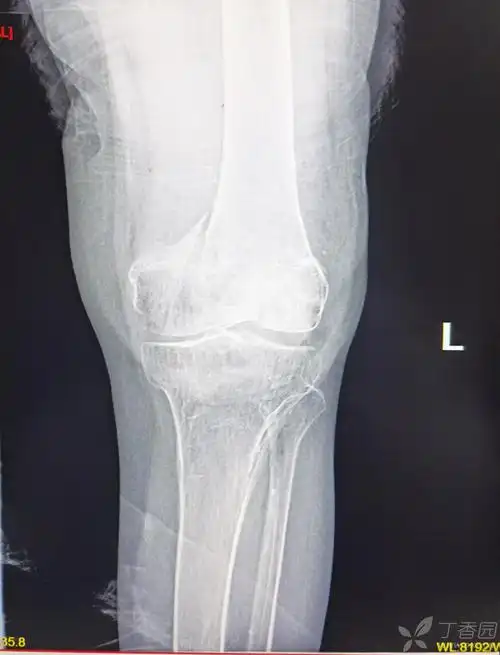 一例股骨髁间粉碎性骨折