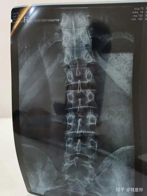 轻度脊柱侧弯兵检可以通关吗? - 知乎