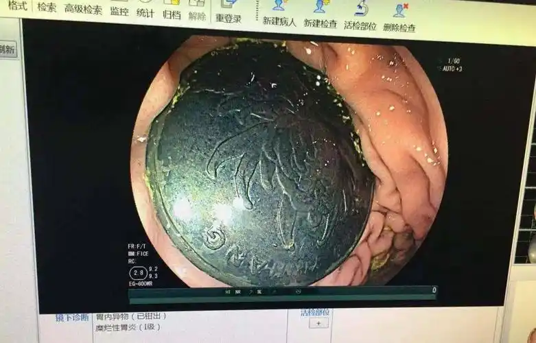 六岁男童误吞一元硬币卡在胃里八天后取出