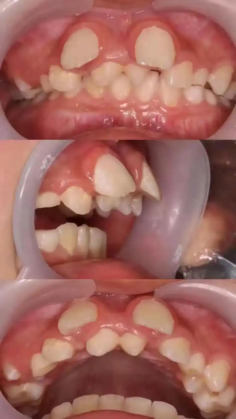 小朋友两颗多生牙未及时拔除,导致门牙外突,影响美观,口腔问题 - 抖音