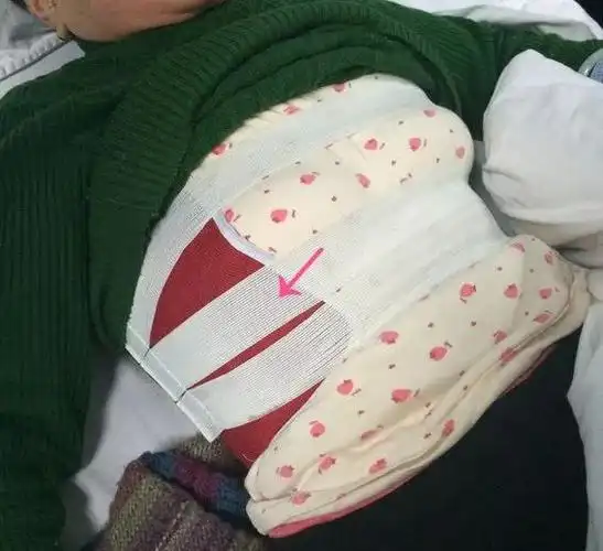 二,闭合性多根多处肋骨骨折前提:镇痛固定:小范围用包扎固定反常呼吸