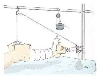 图 8婴幼儿的股骨骨折使用下肢 gallows 牵引或称 bryants 牵引,原理