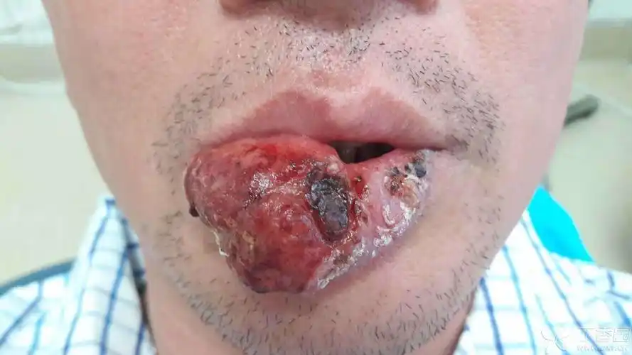 切换新版 >> 不再显示 ×  患者,男性,47岁,下唇反复糜烂,破溃2年.