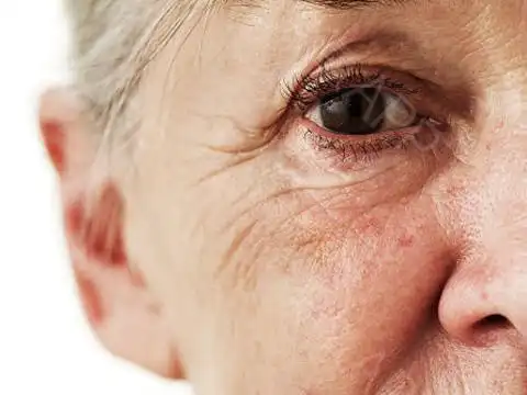 这些皱纹的形成是由于年龄的衰老或者皮肤的状态自然形成的