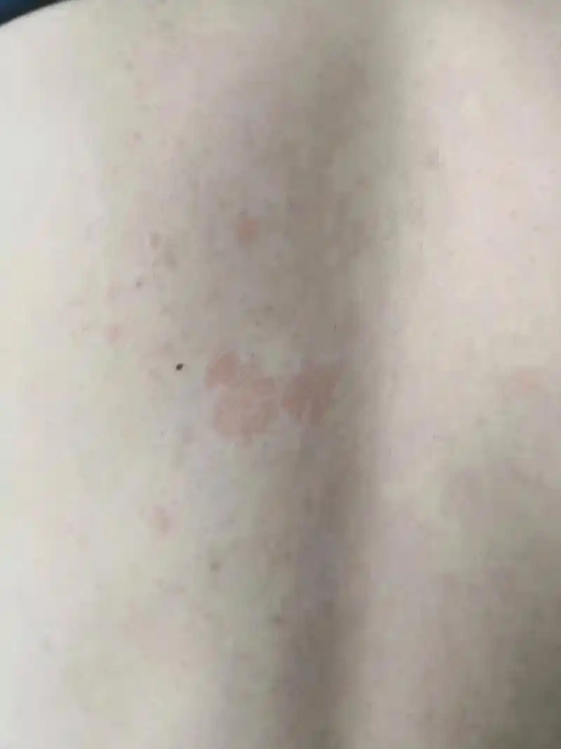 花斑癣夏季高发,长了这种斑,可别掉以轻心,它是一种真菌感染 - 抖音