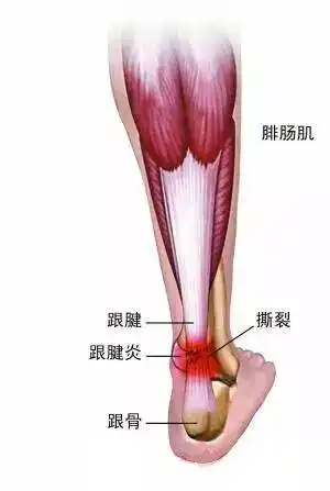 跟腱明明很强壮为什么很容易受伤